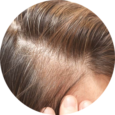 Hair Loss & Fine Hair